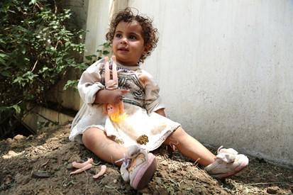 One-year-old Zuhoor was forced to have the fingers of her right hand amputated after being seriously injured by an airstrike near Sana’a