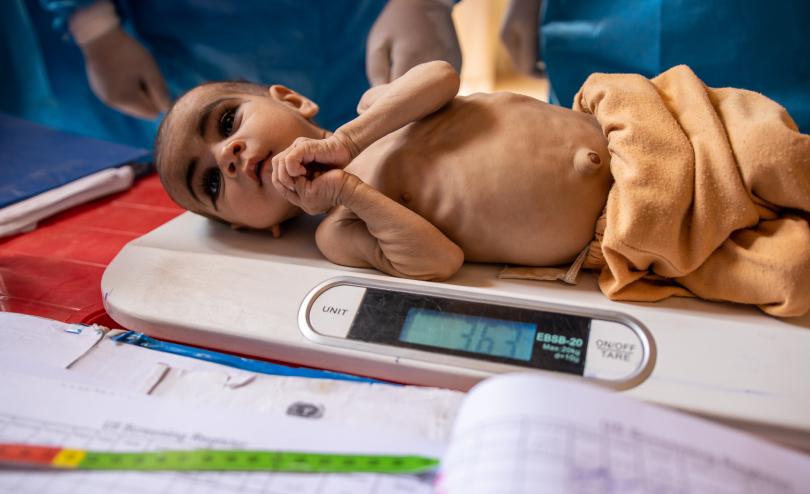 Samera (7 months) is receiving treatment for severe acute malnutrition at a Save the Children mobile clinic in Afghanistan