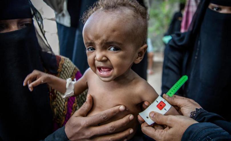 Malnourished newborn being examined by doctor