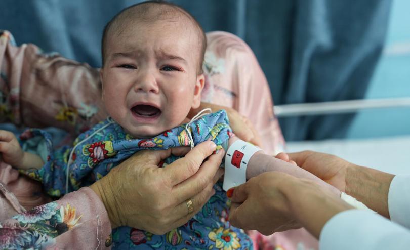 Baby Firoz has malnutrition in Afghanistan 